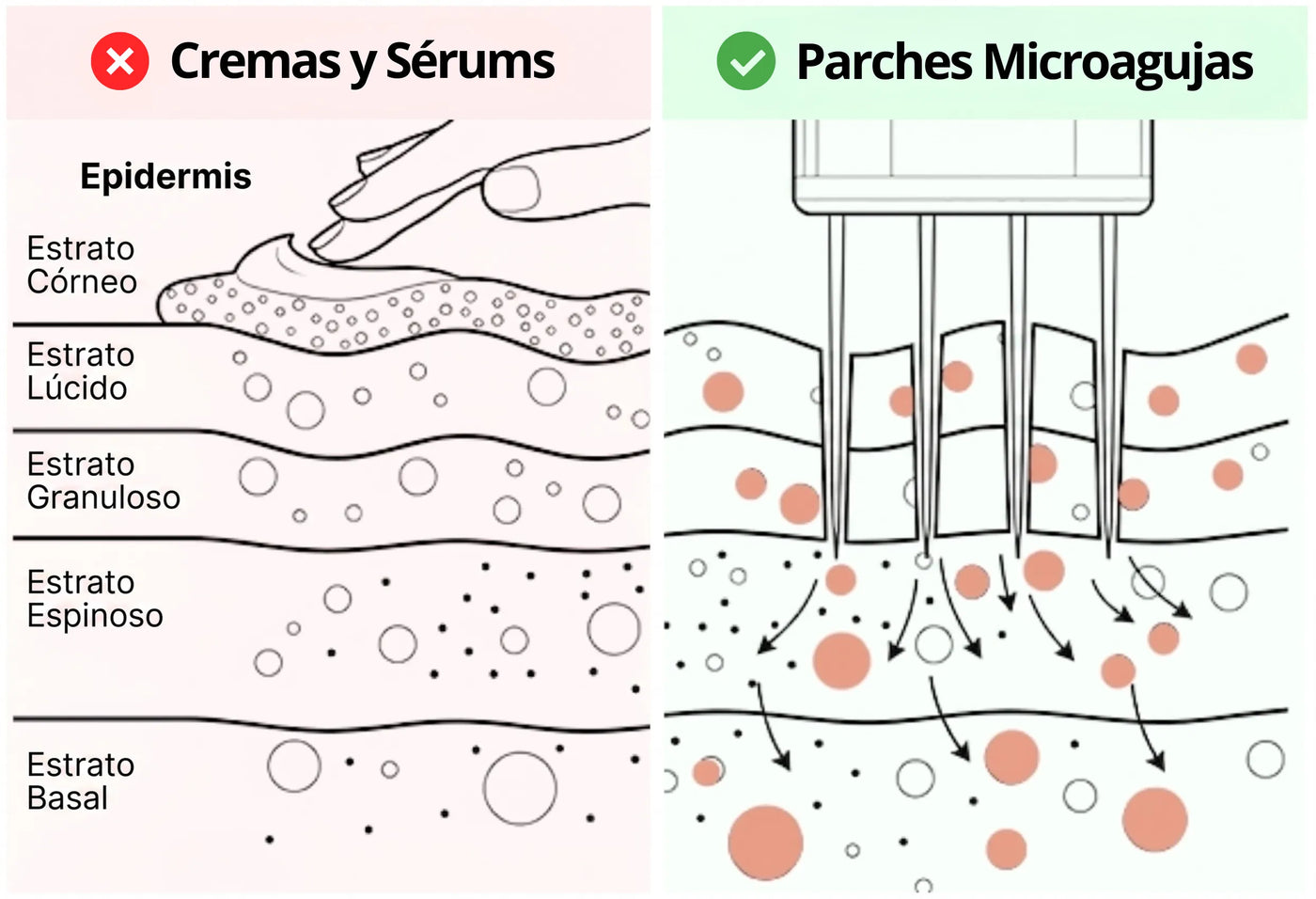 Diagrama: cremas vs microagujas