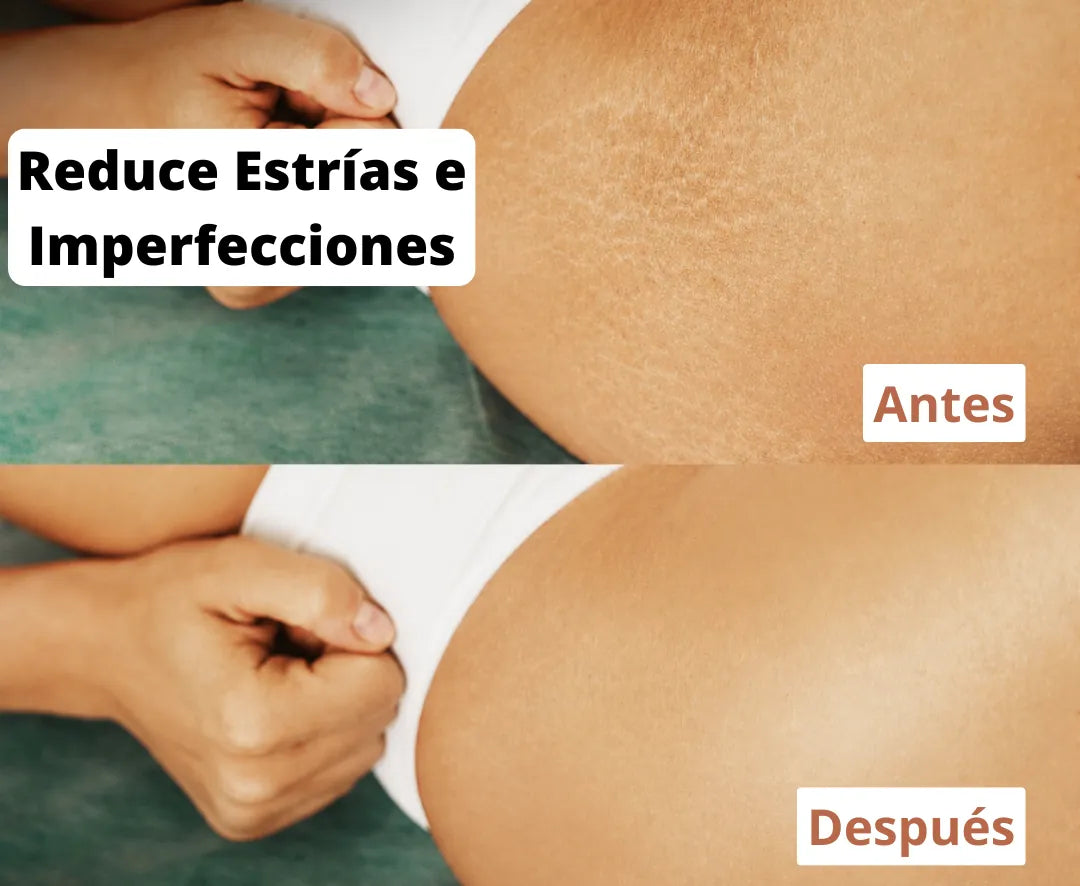 Antes y después: apariencia de estrías atenuada con el Aceite Corporal Mágico
