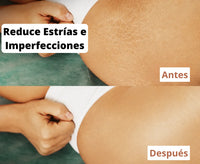 Antes y después: apariencia de estrías atenuada con el Aceite Corporal Mágico