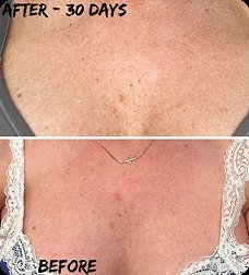 Antes y después en el escote tras 30 días con el Aceite Corporal Mágico